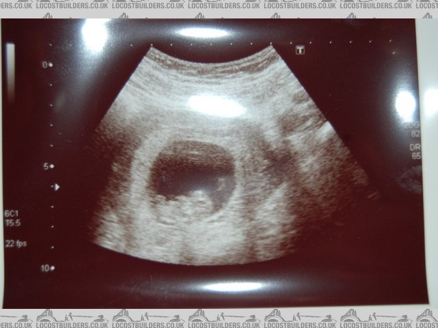 baby scan